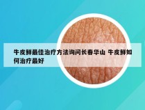 牛皮鲜最佳治疗方法询问长春华山 牛皮鲜如何治疗最好