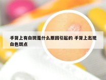 手背上有白斑是什么原因引起的 手背上出现白色斑点