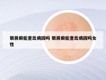 银屑癣能查出病因吗 银屑癣能查出病因吗女性