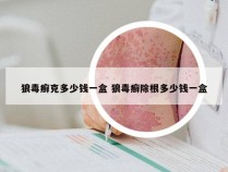 狼毒癣克多少钱一盒 狼毒癣除根多少钱一盒