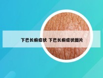 下巴长癣症状 下巴长癣症状图片