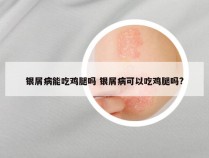 银屑病能吃鸡腿吗 银屑病可以吃鸡腿吗?