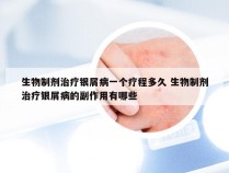 生物制剂治疗银屑病一个疗程多久 生物制剂治疗银屑病的副作用有哪些