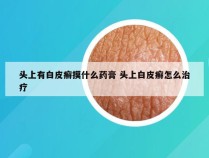 头上有白皮癣摸什么药膏 头上白皮癣怎么治疗