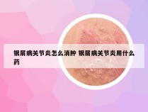 银屑病关节炎怎么消肿 银屑病关节炎用什么药