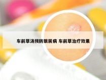 车前草汤预防银屑病 车前草治疗效果