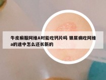 牛皮癣服阿维A时能吃钙片吗 银屑病吃阿维a的途中怎么还长新的