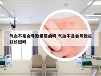 气血不足会导致银屑病吗 气血不足会导致皮肤长斑吗