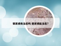 银屑病有治愈吗 银屑病能治愈?