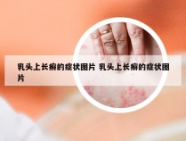 乳头上长癣的症状图片 乳头上长癣的症状图片