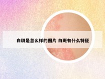 白斑是怎么样的图片 白斑有什么特征