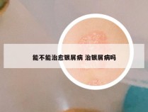 能不能治愈银屑病 治银屑病吗