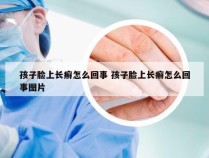 孩子脸上长癣怎么回事 孩子脸上长癣怎么回事图片