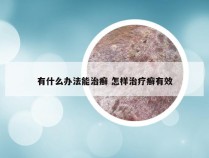 有什么办法能治癣 怎样治疗癣有效