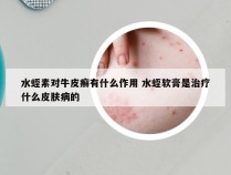 水蛭素对牛皮癣有什么作用 水蛭软膏是治疗什么皮肤病的