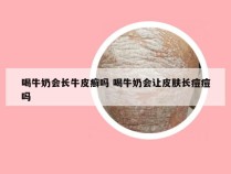 喝牛奶会长牛皮癣吗 喝牛奶会让皮肤长痘痘吗