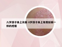 八岁孩子身上长藓 8岁孩子身上有类似癣一样的疙瘩