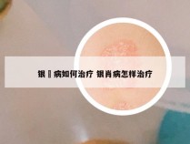 银痟病如何治疗 银肖病怎样治疗