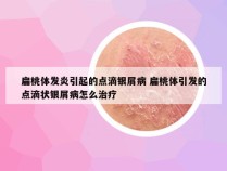 扁桃体发炎引起的点滴银屑病 扁桃体引发的点滴状银屑病怎么治疗