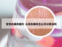 宝宝白癞风图片 小孩白癞风怎么可以根治吗