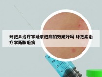 环孢素治疗掌趾脓泡病的效果好吗 环孢素治疗掌跖脓疱病