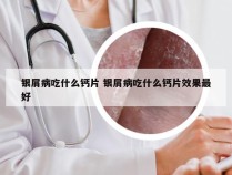 银屑病吃什么钙片 银屑病吃什么钙片效果最好