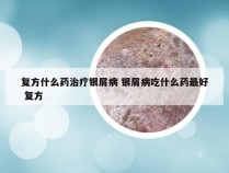 复方什么药治疗银屑病 银屑病吃什么药最好 复方