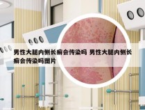 男性大腿内侧长癣会传染吗 男性大腿内侧长癣会传染吗图片