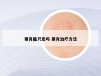 银肖能只愈吗 银肖治疗方法