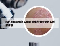 脓疱型银屑病怎么缓解 脓疱型银屑病怎么缓解疼痛