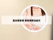 藁本银屑病 银屑病根治秘方