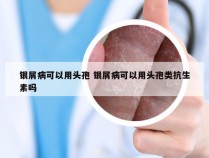 银屑病可以用头孢 银屑病可以用头孢类抗生素吗