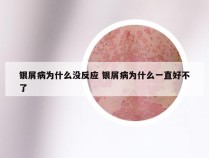 银屑病为什么没反应 银屑病为什么一直好不了