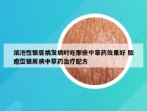 浓泡性银屑病发病时吃那些中草药效果好 脓疱型银屑病中草药治疗配方