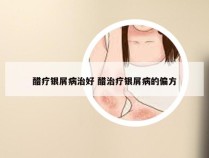 醋疗银屑病治好 醋治疗银屑病的偏方