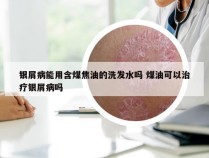 银屑病能用含煤焦油的洗发水吗 煤油可以治疗银屑病吗