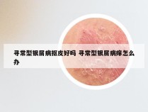 寻常型银屑病抠皮好吗 寻常型银屑病痒怎么办