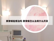 鹅掌癣能根治吗 鹅掌癣怎么治用什么药膏