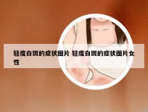 轻度白斑的症状图片 轻度白斑的症状图片女性