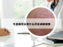 牛皮癣可以用什么药膏减缓病情