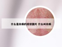 什么是白癣的症状图片 什么叫白癣