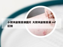 小斑块副银屑病图片 大斑块副银屑病 mf区别