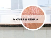 bmp与银屑病 银屑病b27