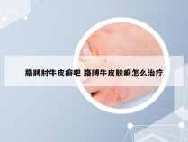 胳膊肘牛皮癣吧 胳膊牛皮肤癣怎么治疗