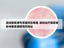 洛阳银屑病专家医院在哪里 洛阳治疗银屑病郑州银屑病研究院地址