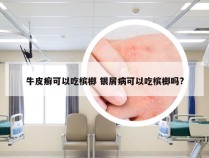 牛皮癣可以吃槟榔 银屑病可以吃槟榔吗?