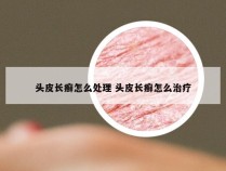 头皮长癣怎么处理 头皮长癣怎么治疗