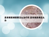 患有银屑病需要怎么治疗好 患有银屑病怎么办