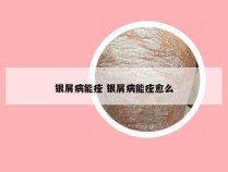 银屑病能痊 银屑病能痊愈么