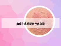 治疗牛皮癣都有什么仪器